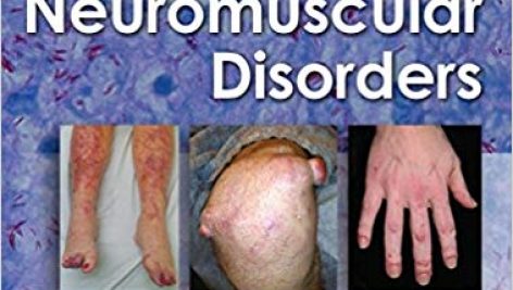 دانلود کتاب Neuromuscular Disorders 2nd Edition