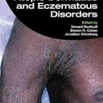 دانلود کتاب Atopic Dermatitis and Eczematous Disorders 2nd Edition